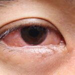 Type of Eye Infections