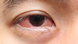 Types of Eye Infections