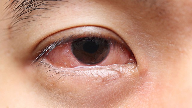 Type of Eye Infections