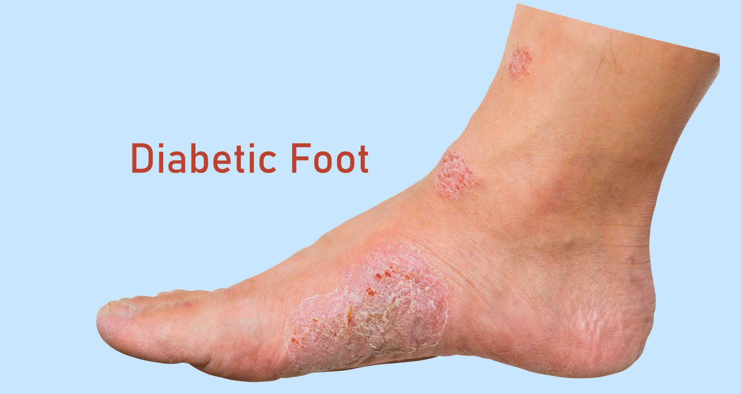 Diabetic Feet