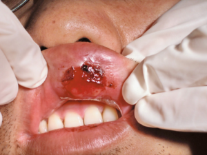 Primary Signs Of Syphilis