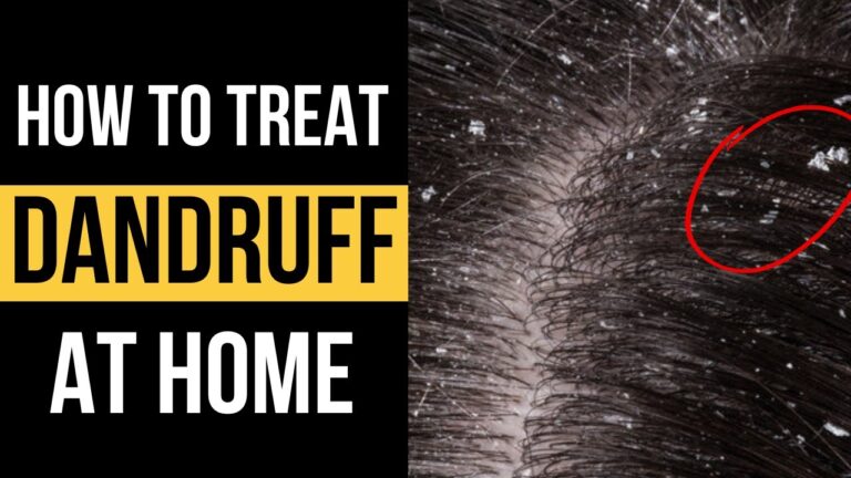 10 natural remedies for dandruff