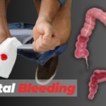Causes of Bleeding From Anus Causes of Bleeding From Anus