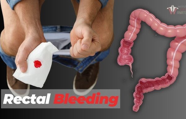 Causes of Bleeding From Anus