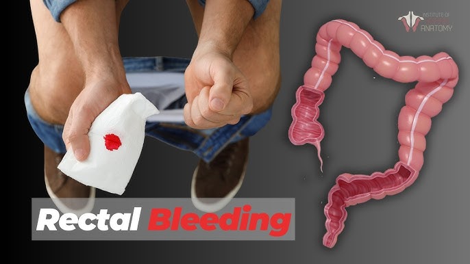 Causes of Bleeding From Anus