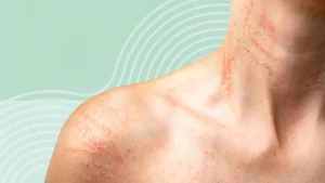 Causes of Red Spots on Skin