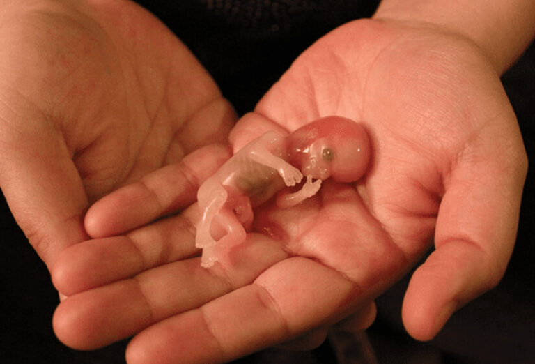 Miscarriage at 6 Months
