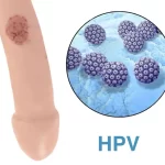 Genital Warts in Men