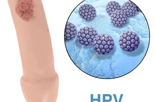 Genital Warts in Men