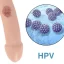 Genital Warts in Men