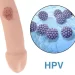 Genital Warts in Men