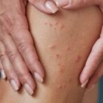How Do I Know If My Rash Is Scabies?