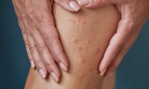 How Do I Know If My Rash Is Scabies?