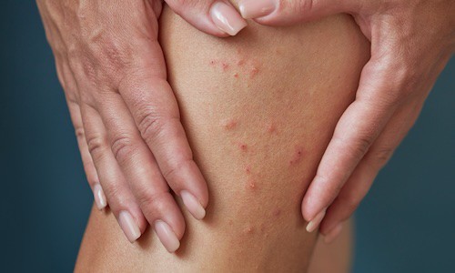 How Do I Know If My Rash Is Scabies?
