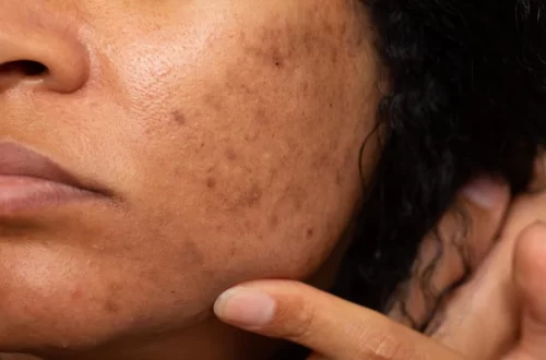 Dark Spot Skin Treatment