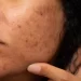 Dark Spot Skin Treatment