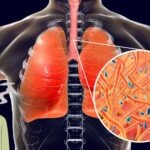 Natural Remedies for Lung Cancer