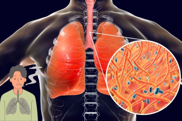 Natural Remedies for Lung Cancer