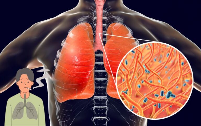 Natural Remedies for Lung Cancer