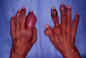 Food for uric acid patients 