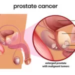 Natural Remedies for Prostate Cancer