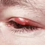 Home Remedies for Eye Problems