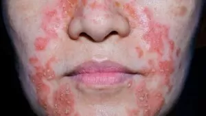 Foods for Dermatitis 