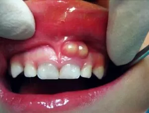 home treatment for a tooth abscess