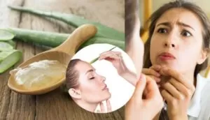 Acne treatment at home 