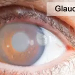 Glaucoma Natural Remedies