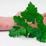Home Remedies for Poison Ivy