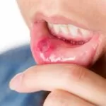 Home Remedies for Mouth Ulcers