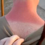 Natural Remedies for Sunburn