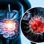 Best Diet for Cancer Prevention