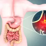 Foods That Help Heal A Stomach Ulcer