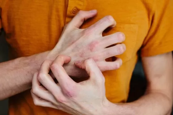 Skin Rashes from Stress