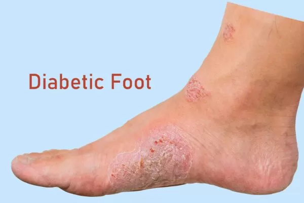 Diabetic Feet