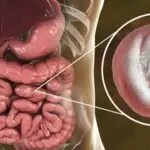 Types of Stomach Infections