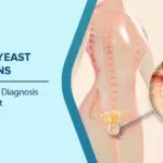 How to Cure Yeast Infection at Home