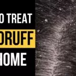 10 natural remedies for dandruff