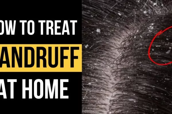 10 natural remedies for dandruff