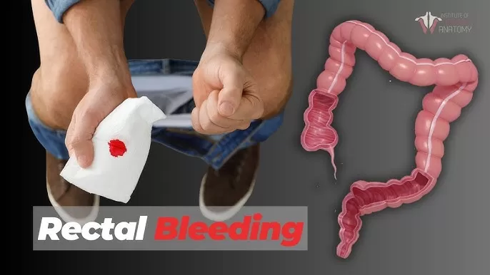 Causes of Bleeding From Anus